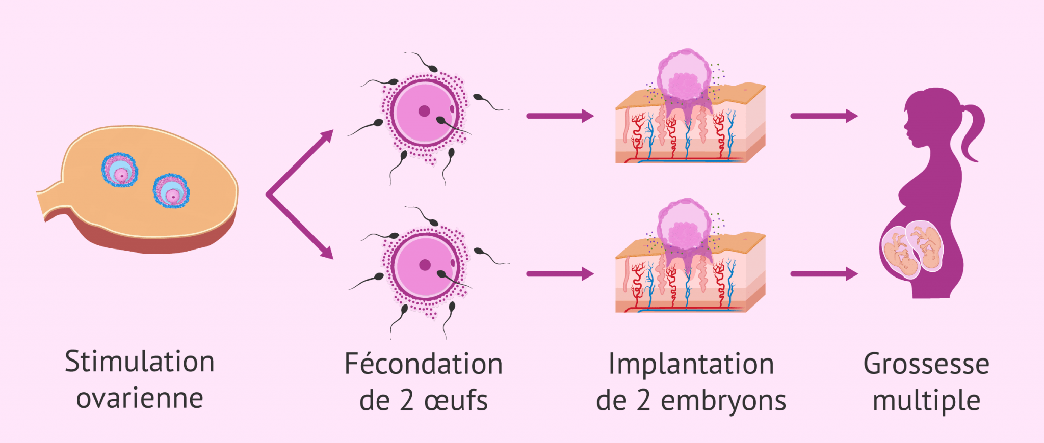 Grossesse multiple par insémination artificielle (IA)