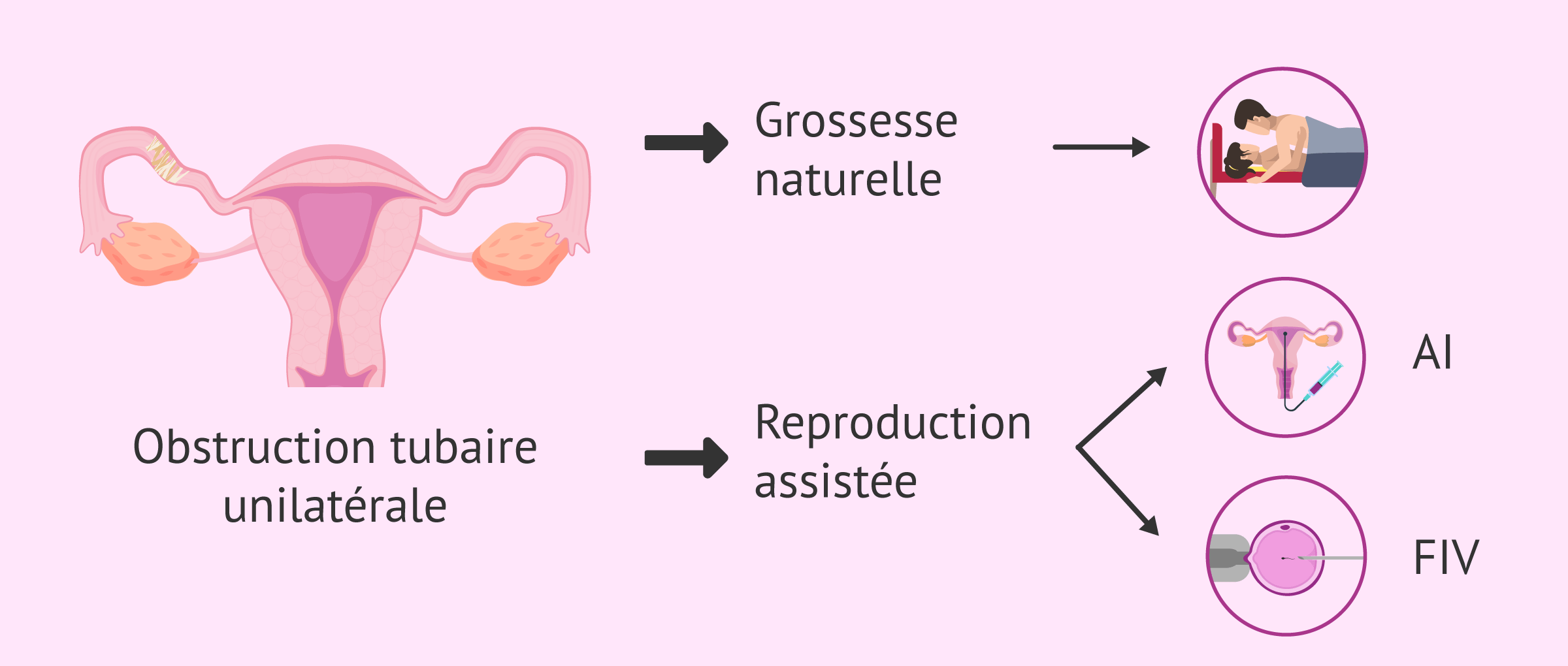 Imagen: Grossesse avec obstruction tubaire unilatérale