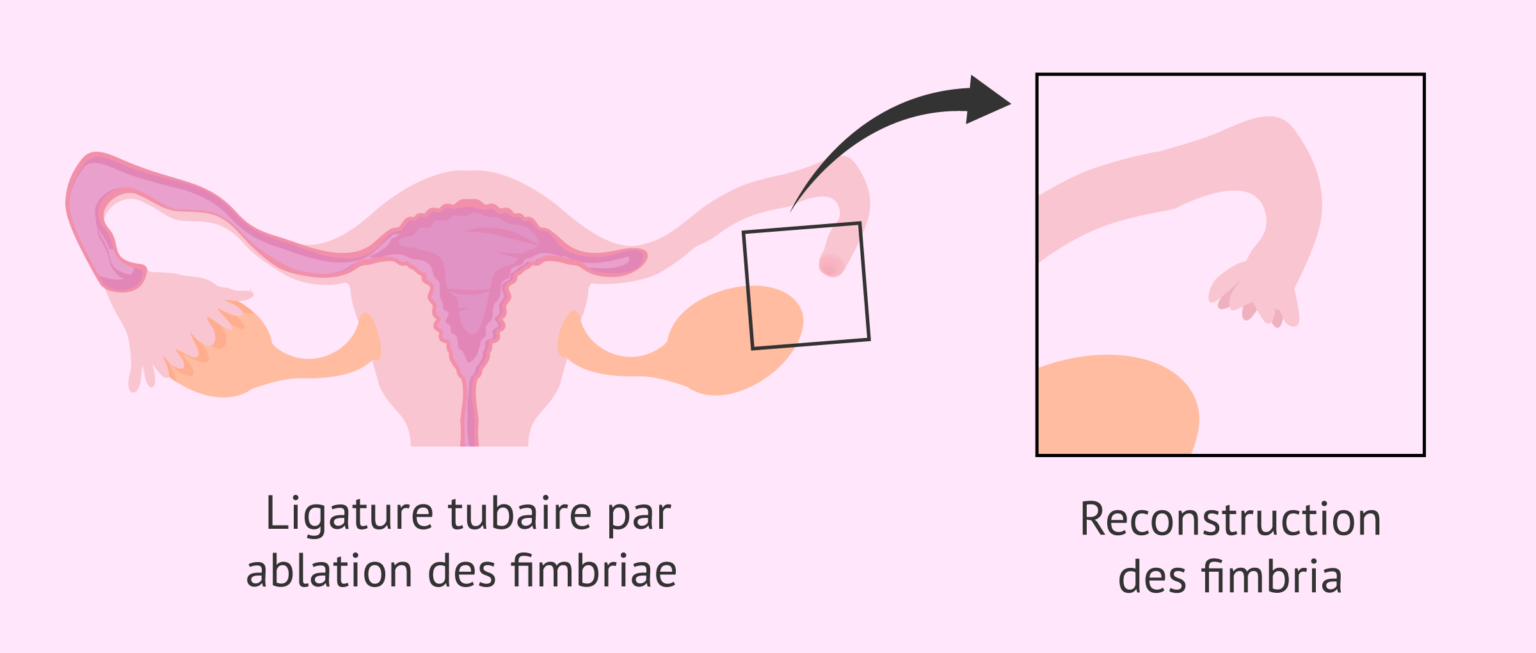 La ligature des trompes estelle réversible?