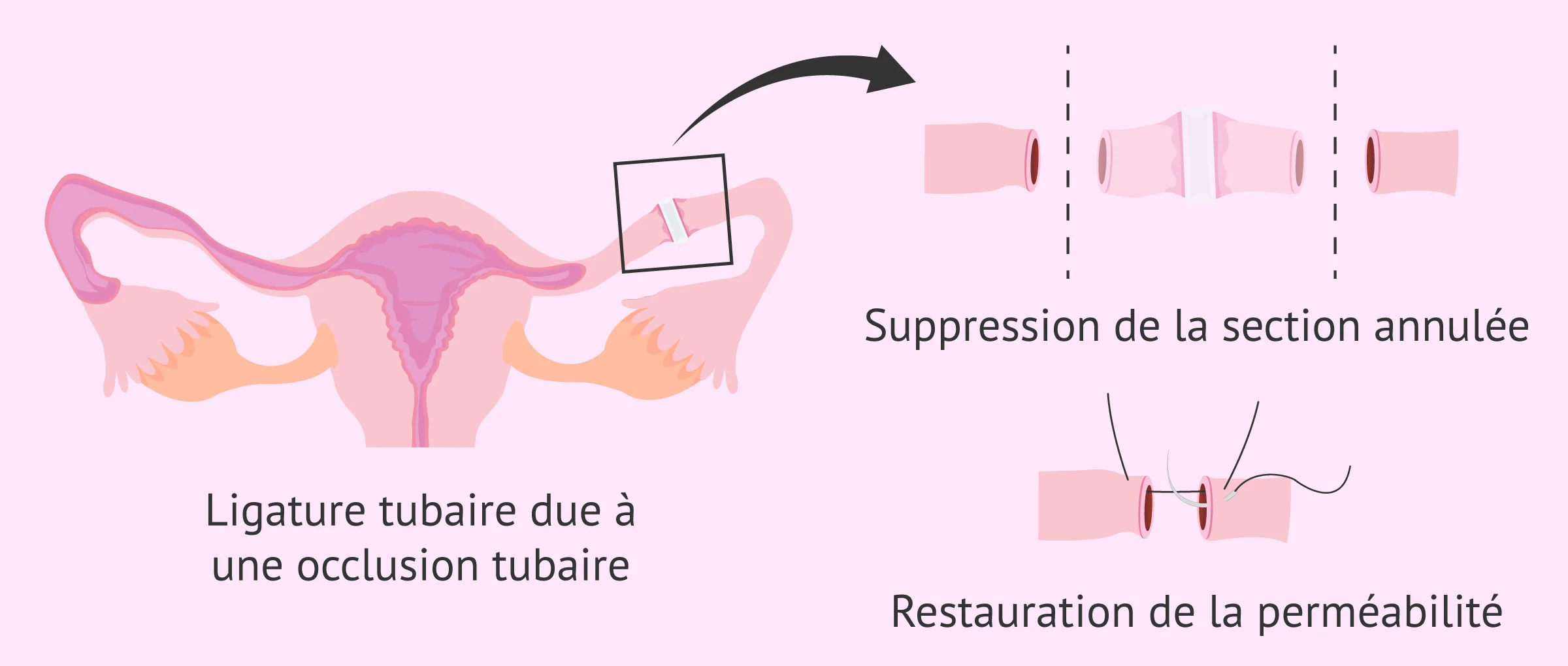 Inversion de la ligature des trompes par occlusion
