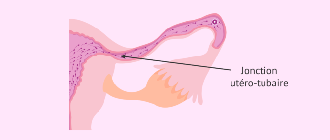 Imagen: La jonction utéro-tubaire : la partie la plus étroite du trajet des spermatozoïdes