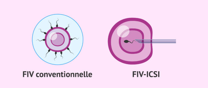 Imagen: FIV conventionnelle - ICSI