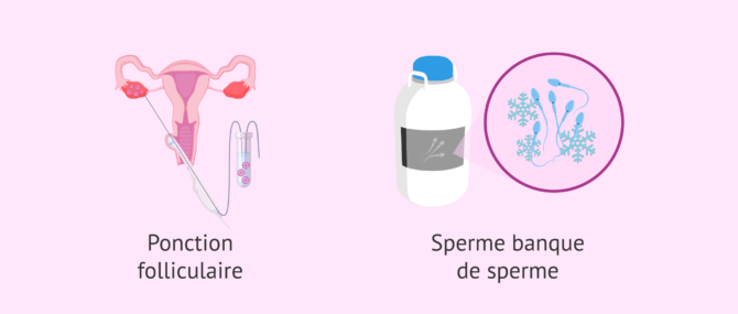 Imagen: Ponction folliculaire et capacitation des spermatozoïdes