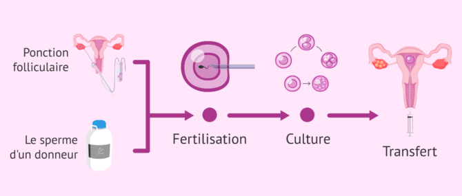 FIV avec sperme de donneur: indications et déroulement du traitement