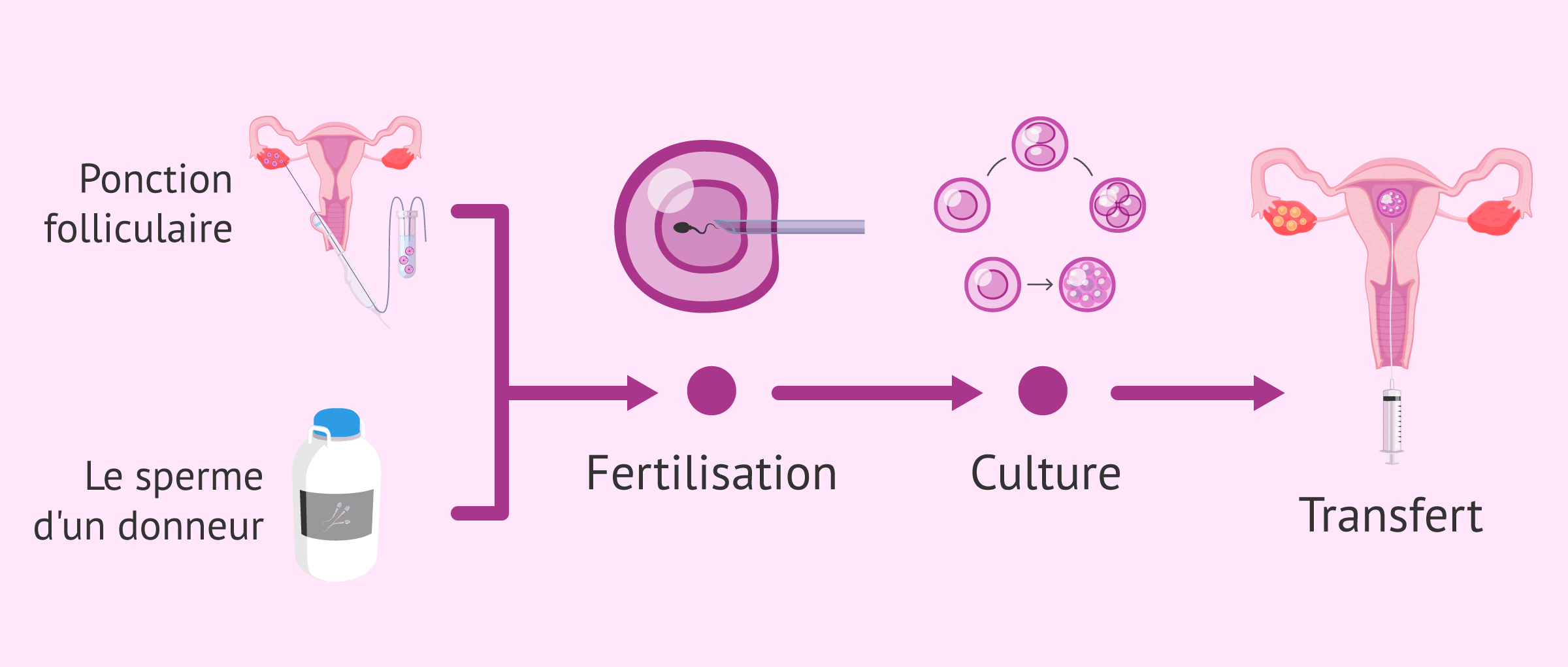 Processus de FIV avec sperme de donneur