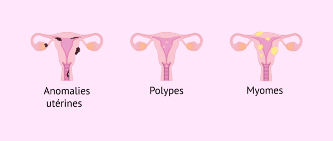 Imagen: Quelques causes endométriales affectant l'implantation embryonnaire