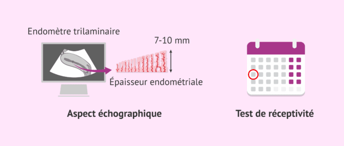 Imagen: Évaluation échographique de l'endomètre et fenêtre d'implantation