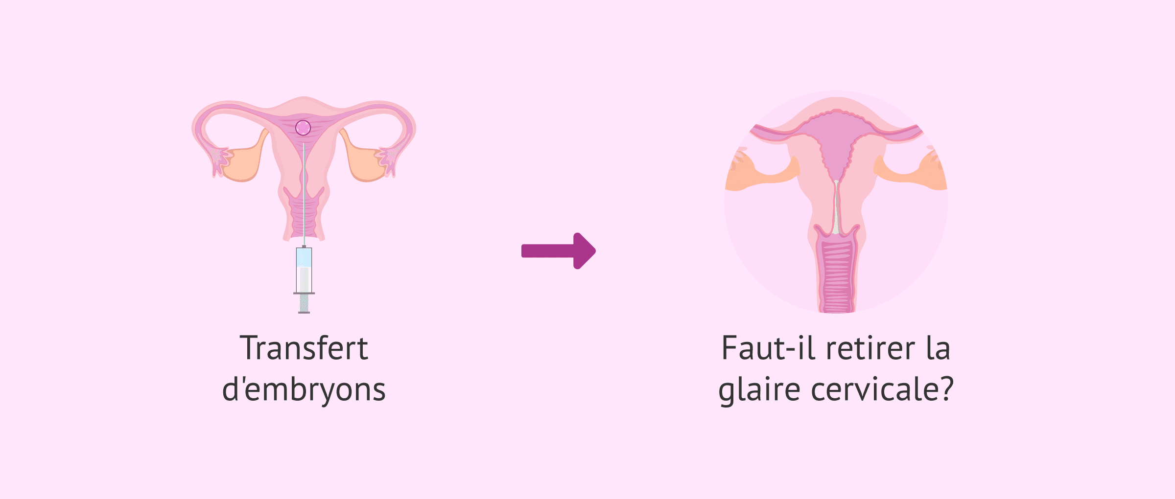 Nettoyer la glaire cervicale en FIV : Pourquoi cette étape médicale est superflue