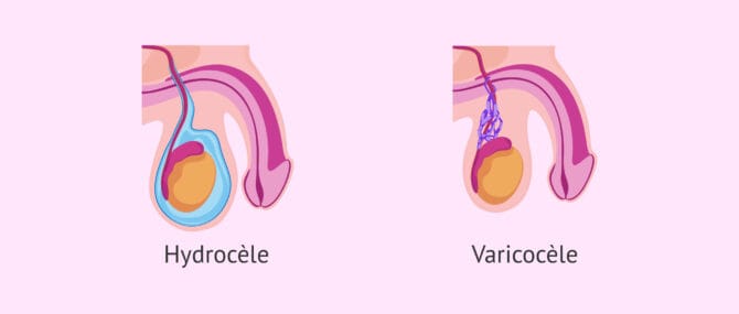 Imagen: Différences entre hydrocèle et varicocèle