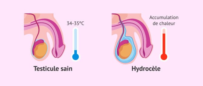 Imagen: Hydrocèle et température testiculaire