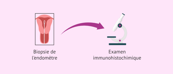 Imagen: Problèmes pour le diagnostic de l'endométrite chronique