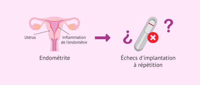 Imagen: L'endométrite chronique et son implication dans l'échec d'implantation