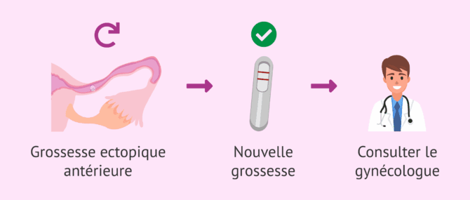 Imagen: Grossesse après une grossesse ectopique antérieure