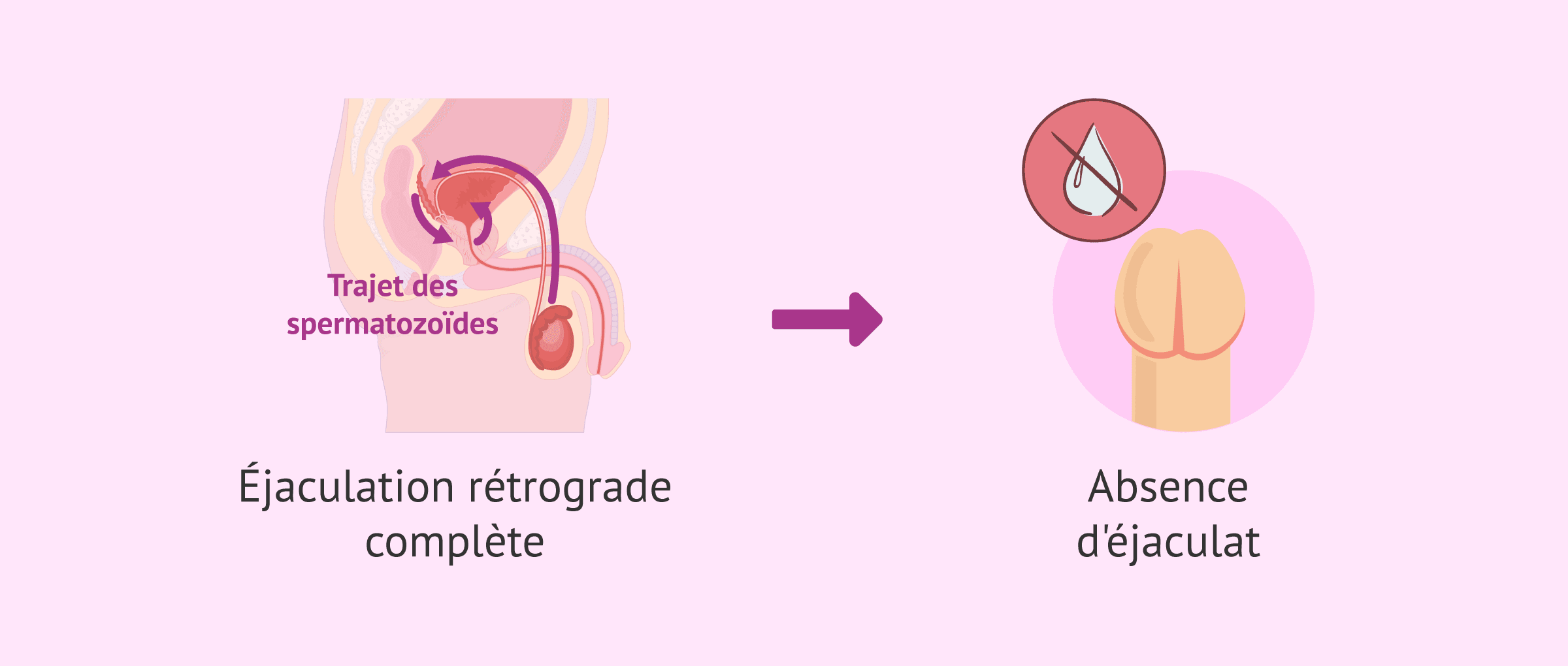 Imagen: Conséquences de l'éjaculation rétrograde complète