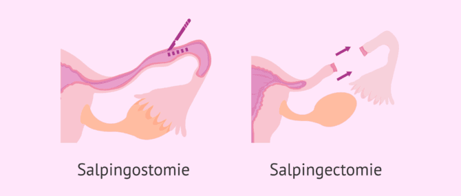 Imagen: Salpingostomie et salpingectomie pour le traitement de la grossesse ectopique