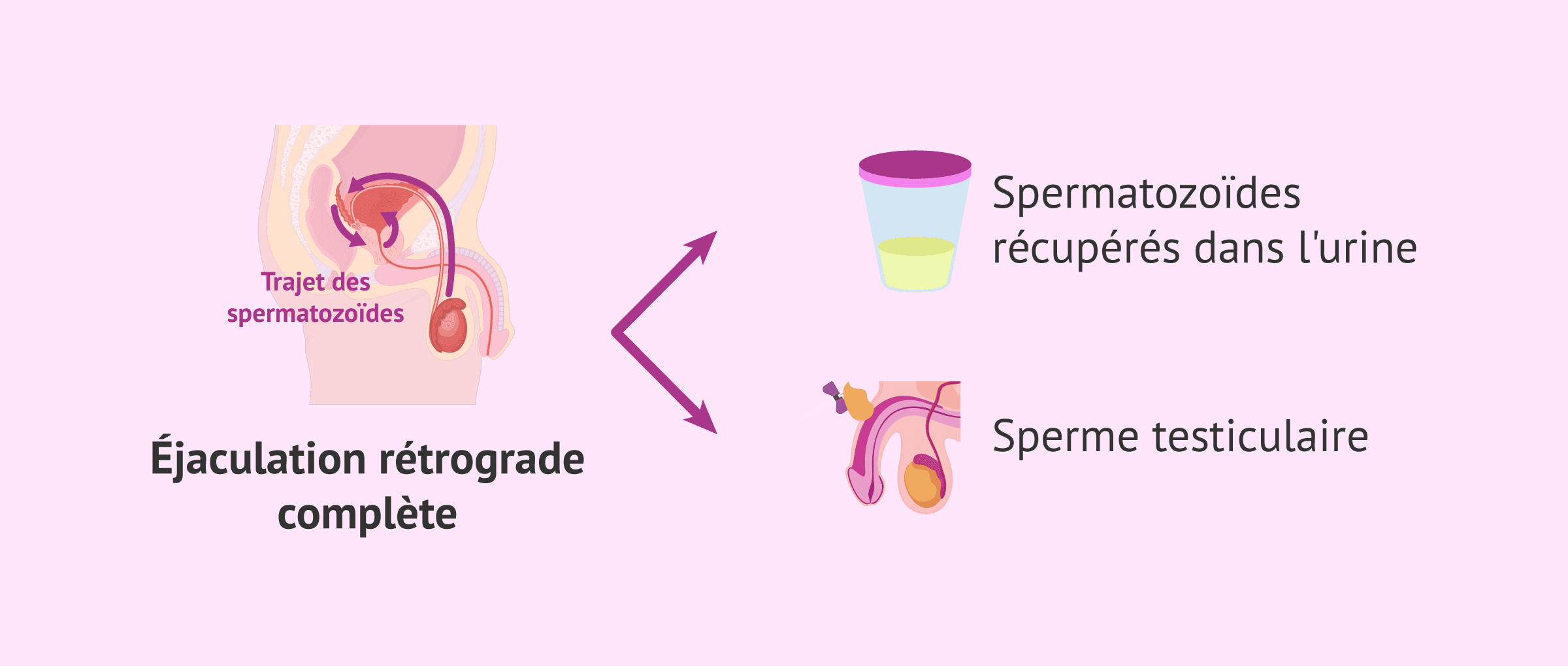 FIV avec éjaculation rétrograde : le secret pour obtenir une grossesse