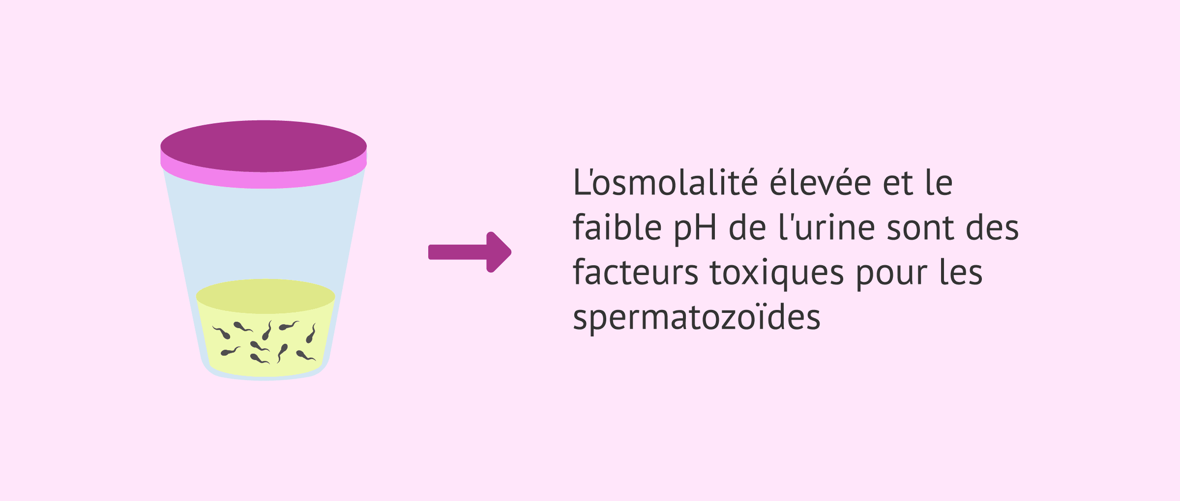Imagen: Spermatozoïdes dans l'urine après une éjaculation rétrograde